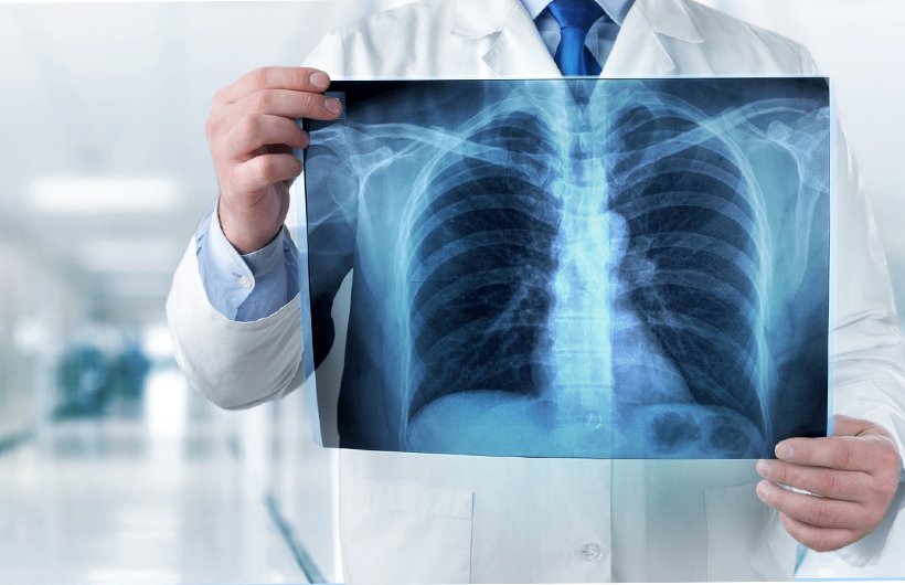 ecmo x-ray