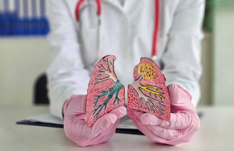Airway Stenosis Repair in Hyderabad