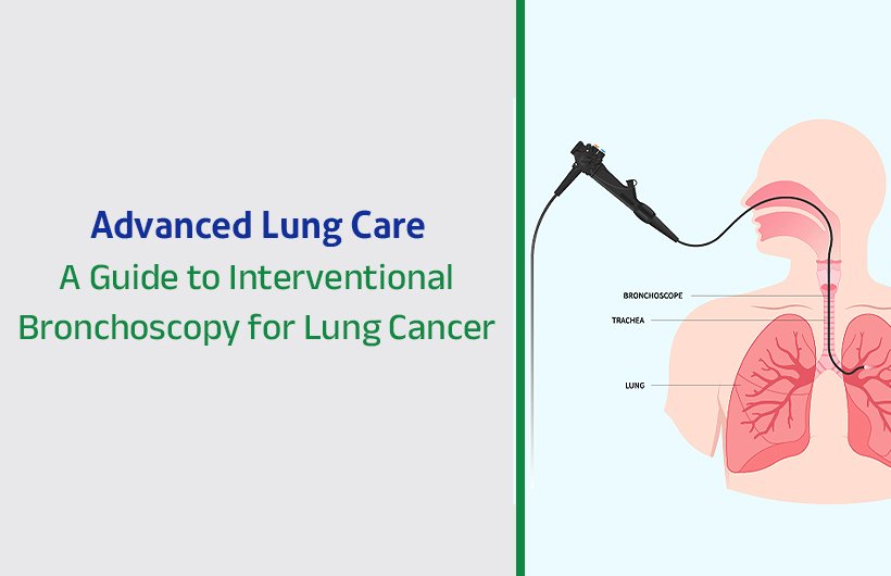 Interventional Bronchoscopy for Lung Cancer